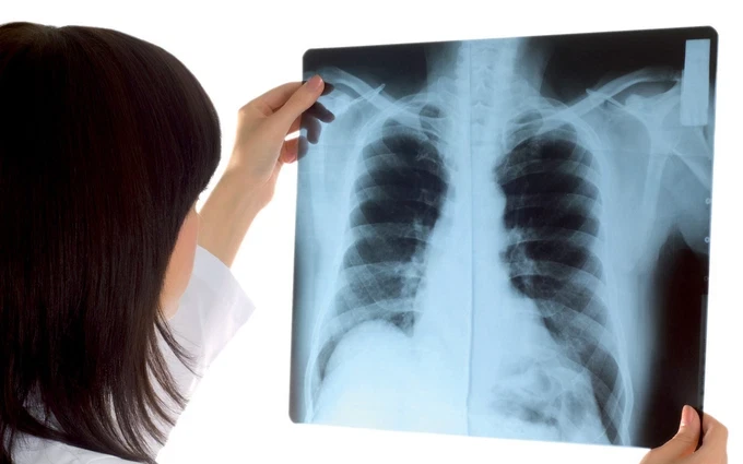 Xét nghiệm chức năng phổi bao gồm những gì?