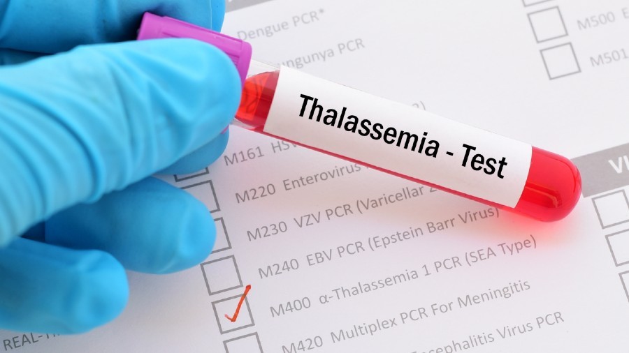 Xét nghiệm Thalassemia hết bao nhiêu tiền? Xét nghiệm Thalassemia ở đâu? - <strong>Klept.com.vn</strong>” width=”600″ height=”337″ data-lazy-sizes=”(max-width: 600px) 100vw, 600px” title=”xet-nghiem-thalassemia-het-bao-nhieu-tien-3″><figcaption id=